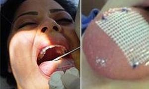 Tirita cosida a la lengua para adelgazar./