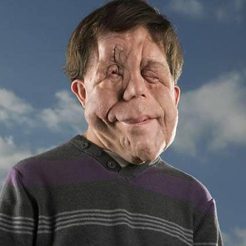 La emotiva historia de Adam Pearson El Correo